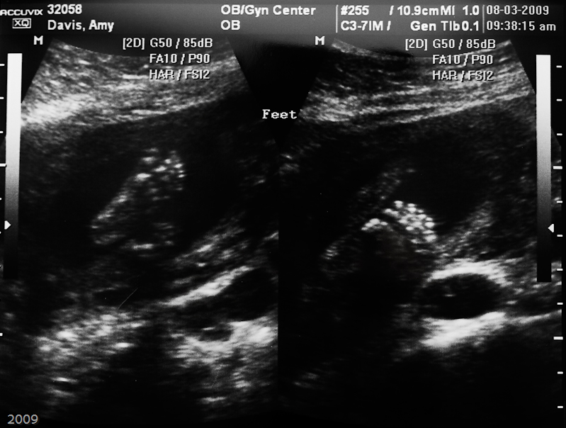 Baby's Feet at 20 weeks
